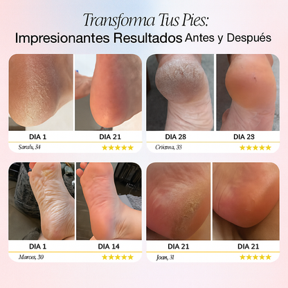 Removedor Belura Pro1 I Edición Limitada